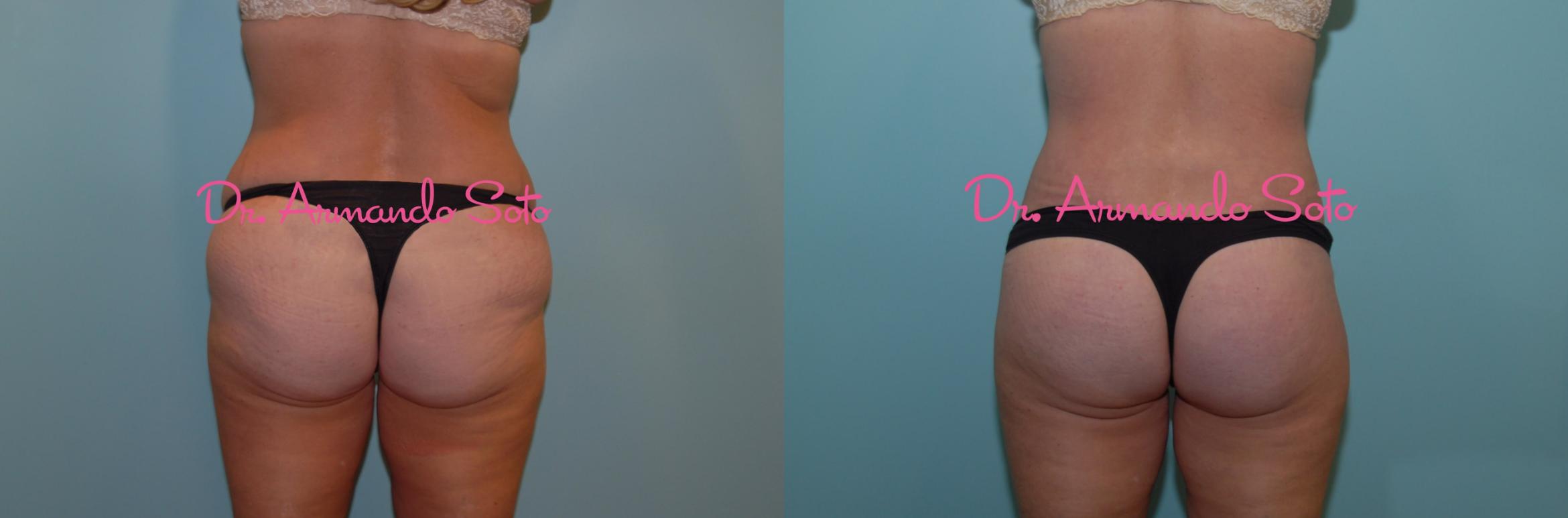 Before & After Lower Body Lift Case 23454 View #2 View in Orlando, FL