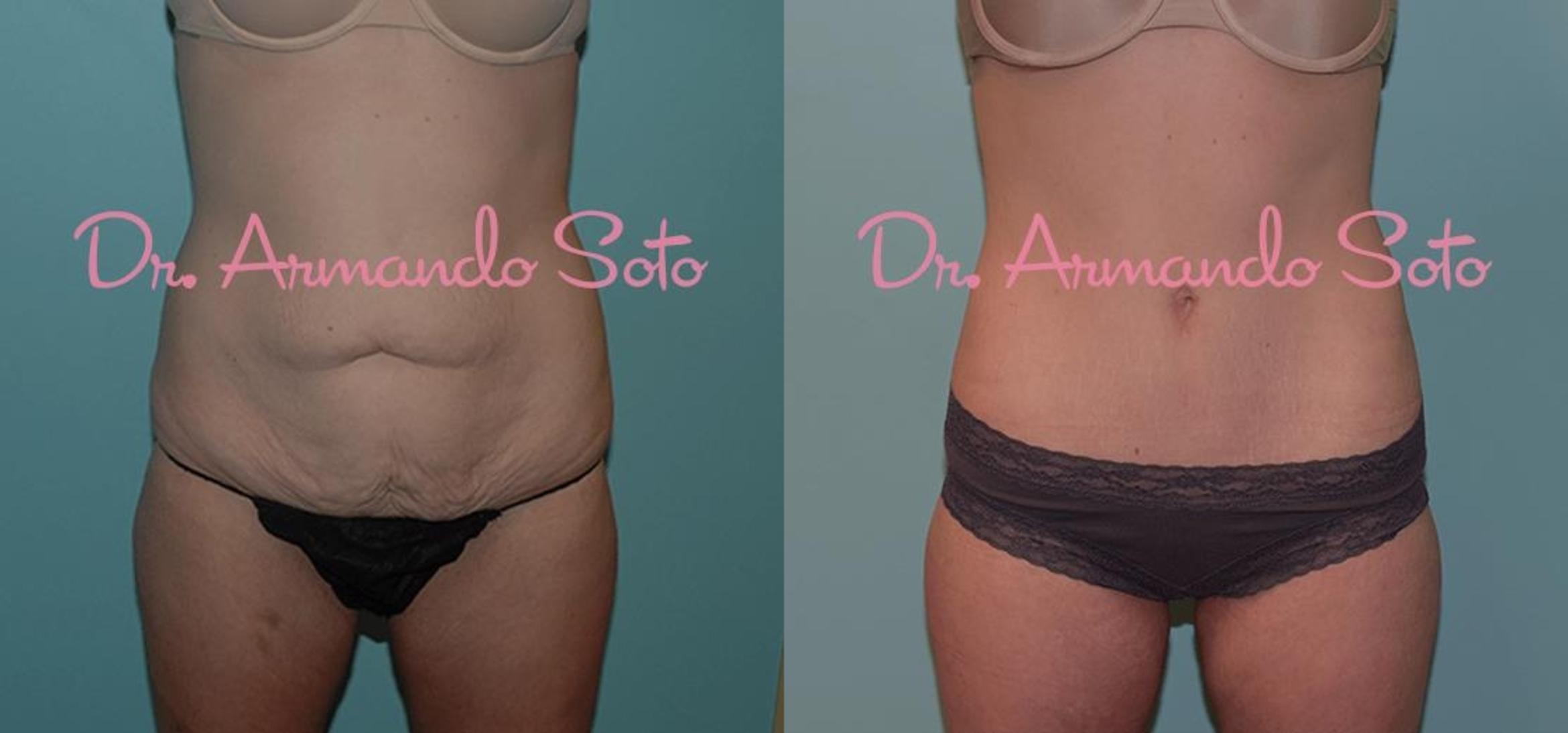 Before & After Lower Body Lift Case 23688 View #1 View in Orlando, FL