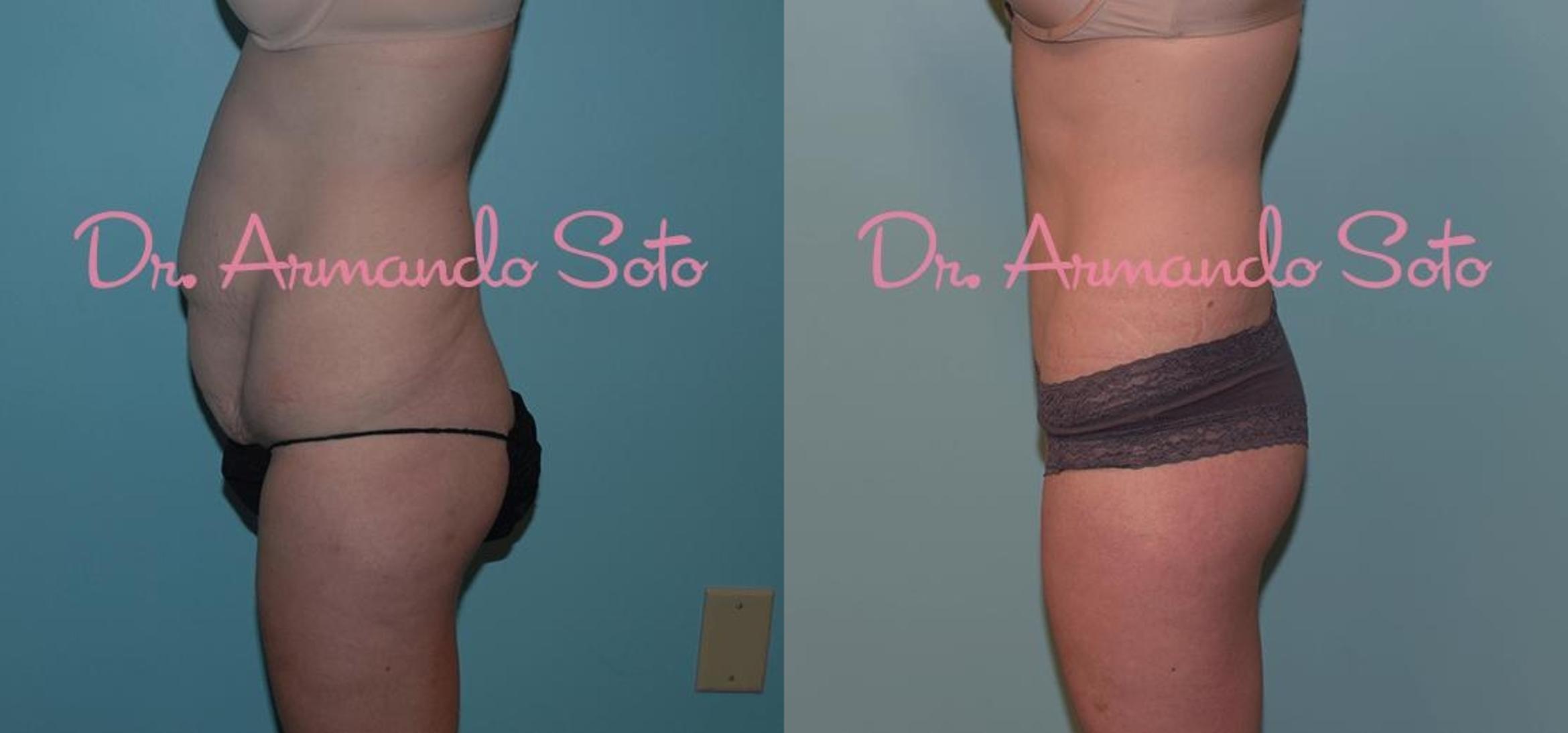 Brazilian Butt Lift in Orlando, Winter Park, FL  Aesthetic Enhancements  Plastic Surgery & Laser Center: Armando Soto, MD