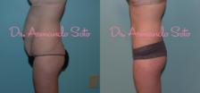 Before & After Lower Body Lift Case 23688 View #2 View in Orlando, FL