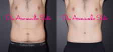 Before & After Lower Body Lift Case 40504 View #1 View in Orlando, FL