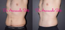Before & After Lower Body Lift Case 40504 View #2 View in Orlando, FL