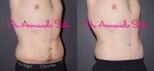 Before & After Lower Body Lift Case 40504 View #3 View in Orlando, FL