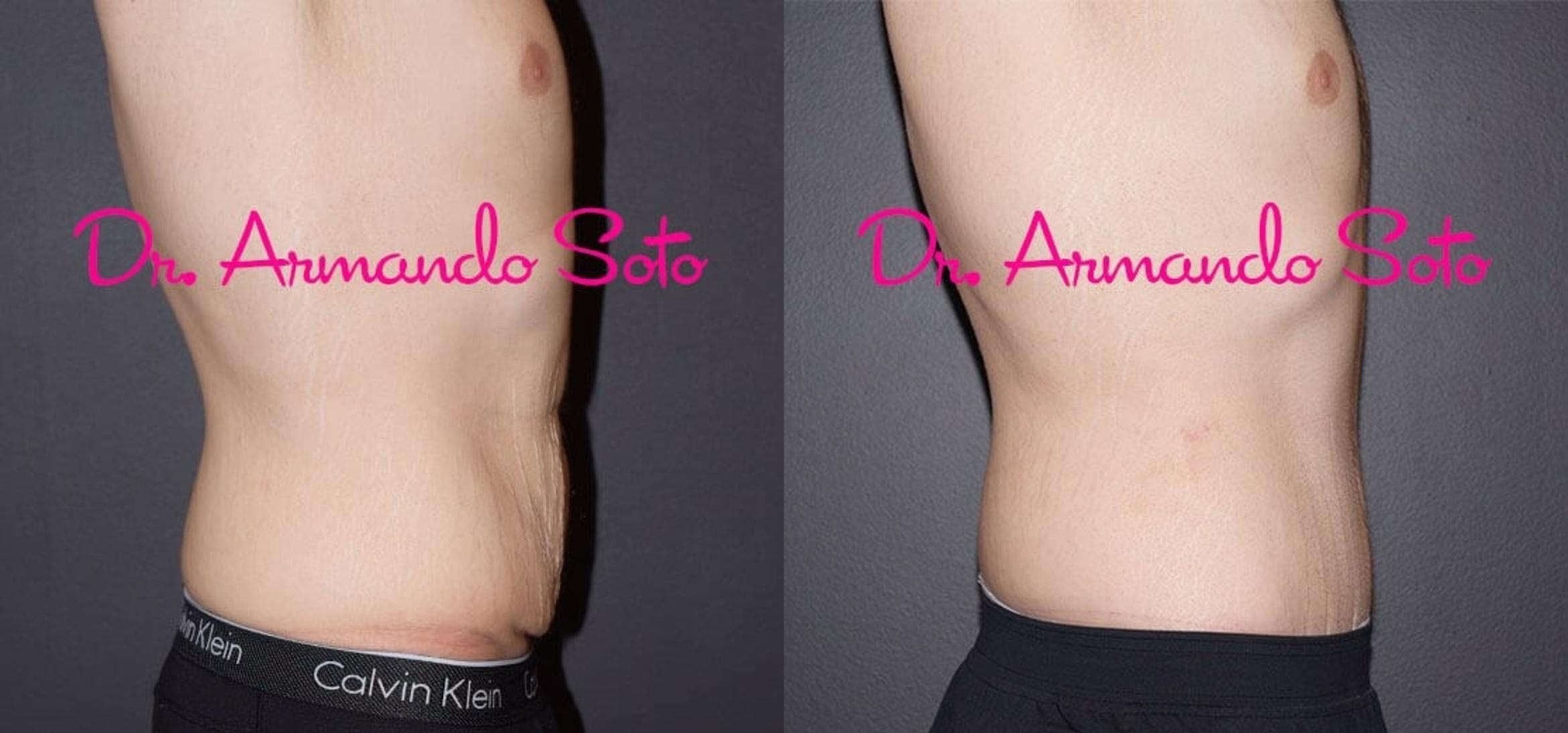 Before & After Lower Body Lift Case 40504 View #4 View in Orlando, FL