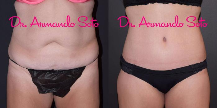 Before & After Lower Body Lift Case 49389 View #1 View in Orlando, FL