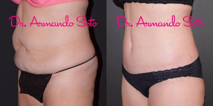 Before & After Lower Body Lift Case 49389 View #2 View in Orlando, FL