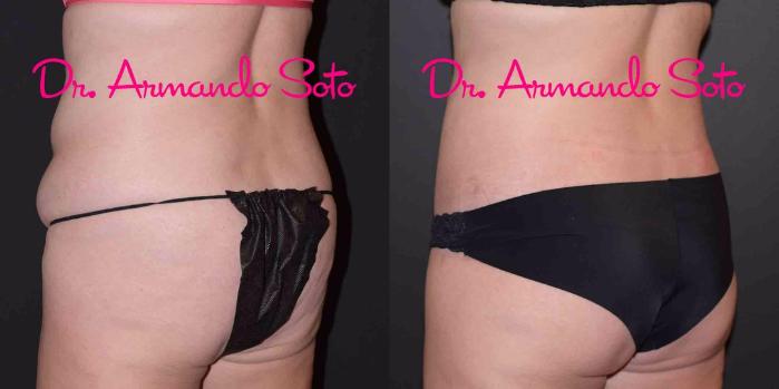 Before & After Lower Body Lift Case 49389 View #4 View in Orlando, FL