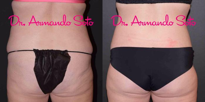 Before & After Lower Body Lift Case 49389 View #5 View in Orlando, FL