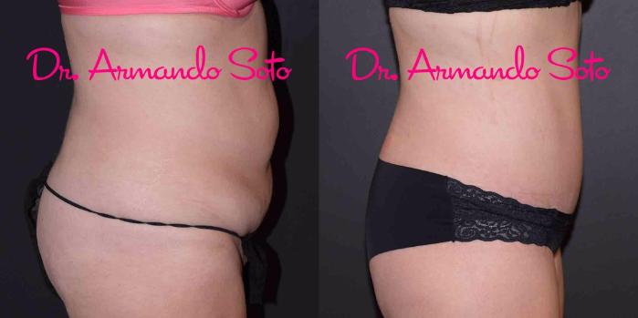 Before & After Lower Body Lift Case 49389 View #7 View in Orlando, FL