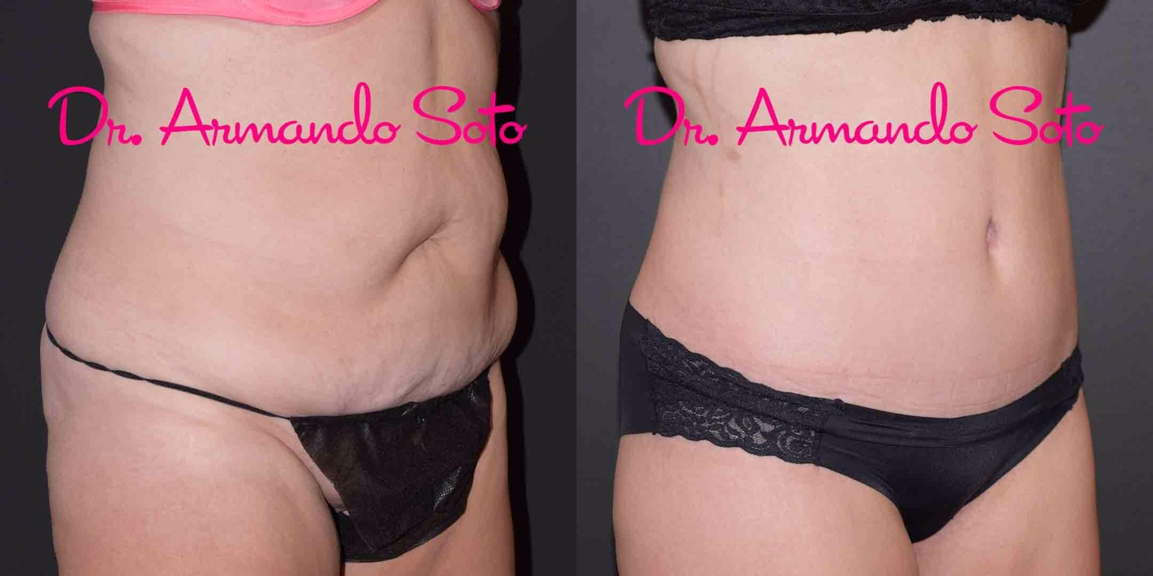 Before & After Lower Body Lift Case 49389 View #8 View in Orlando, FL