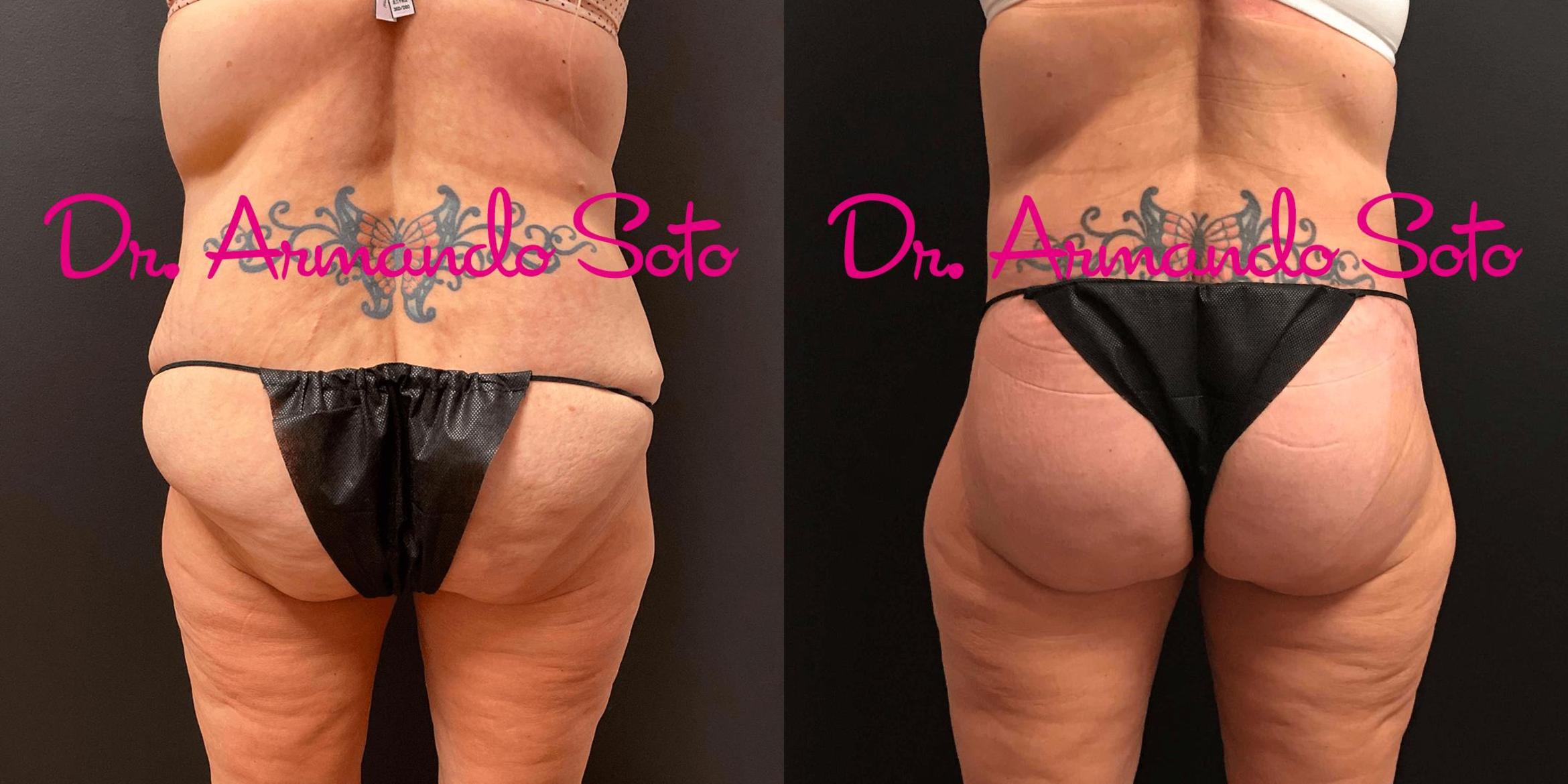Before & After Lower Body Lift Case 69048 View #1 View in Orlando, FL