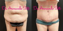Before & After Lower Body Lift Case 70173 View #1 View in Orlando, FL