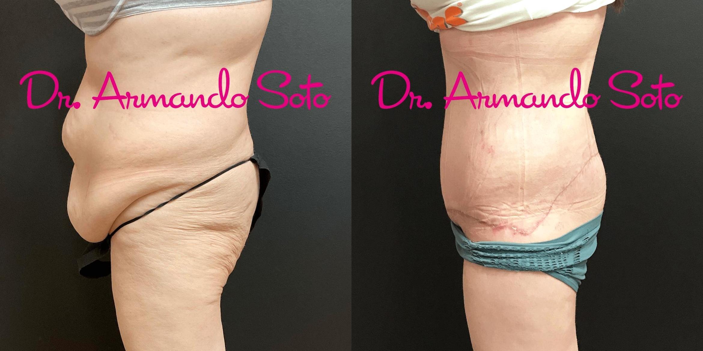 Before & After Lower Body Lift Case 70173 View #2 View in Orlando, FL