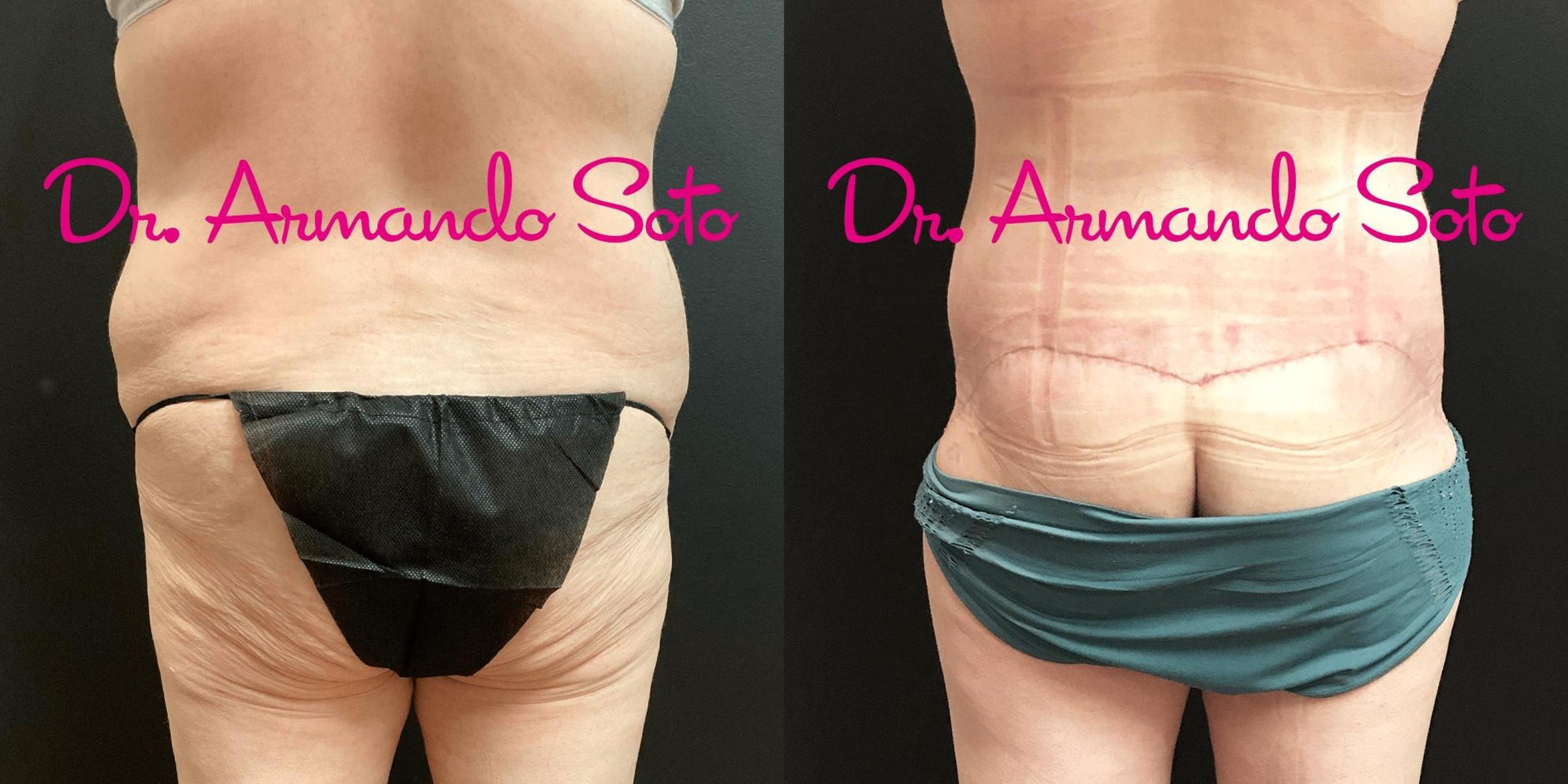 Before & After Lower Body Lift Case 70173 View #3 View in Orlando, FL