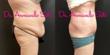 Before & After Lower Body Lift Case 70173 View #4 View in Orlando, FL