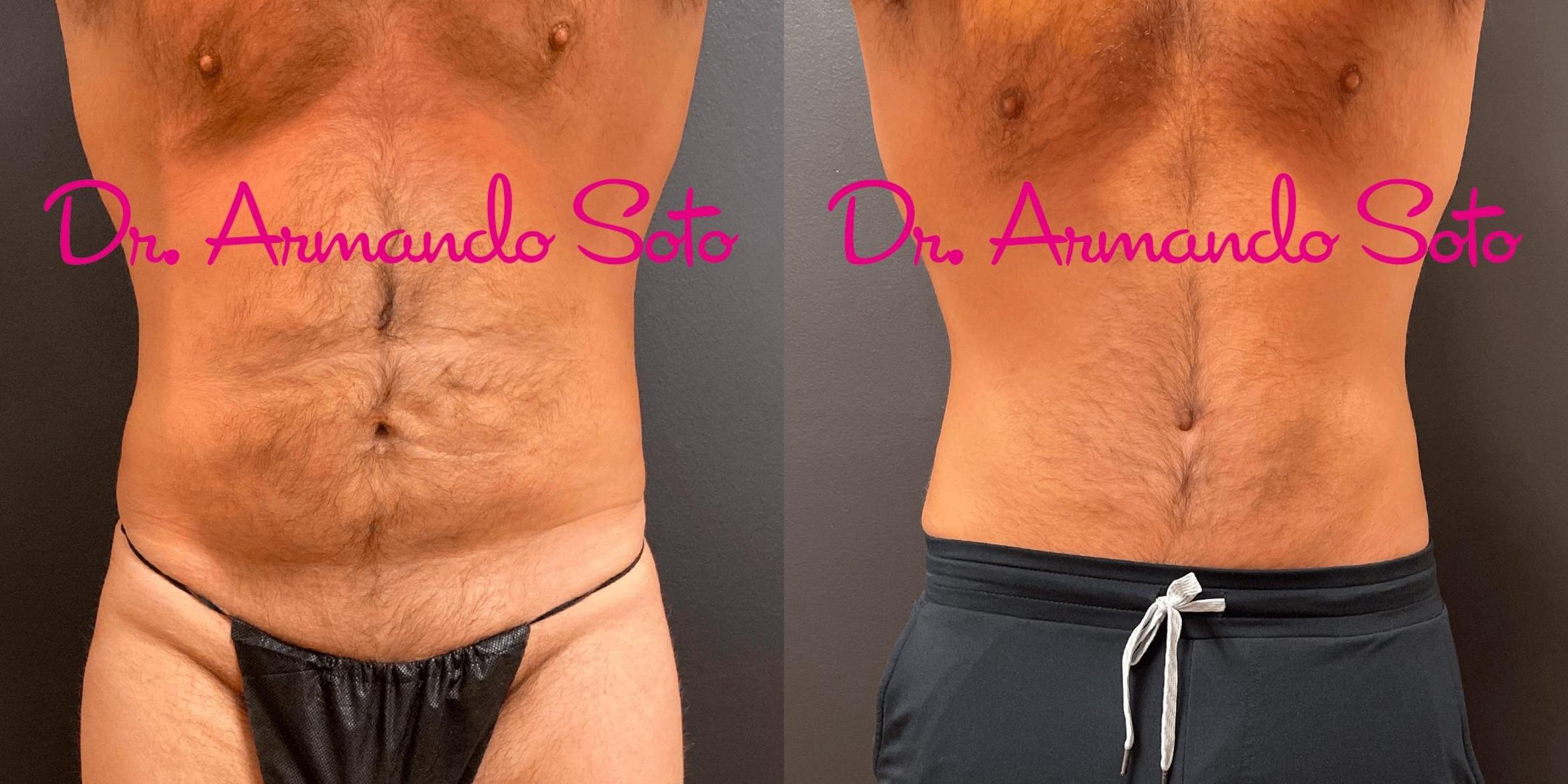 Before & After Lower Body Lift Case 71164 View #1 View in Orlando, FL