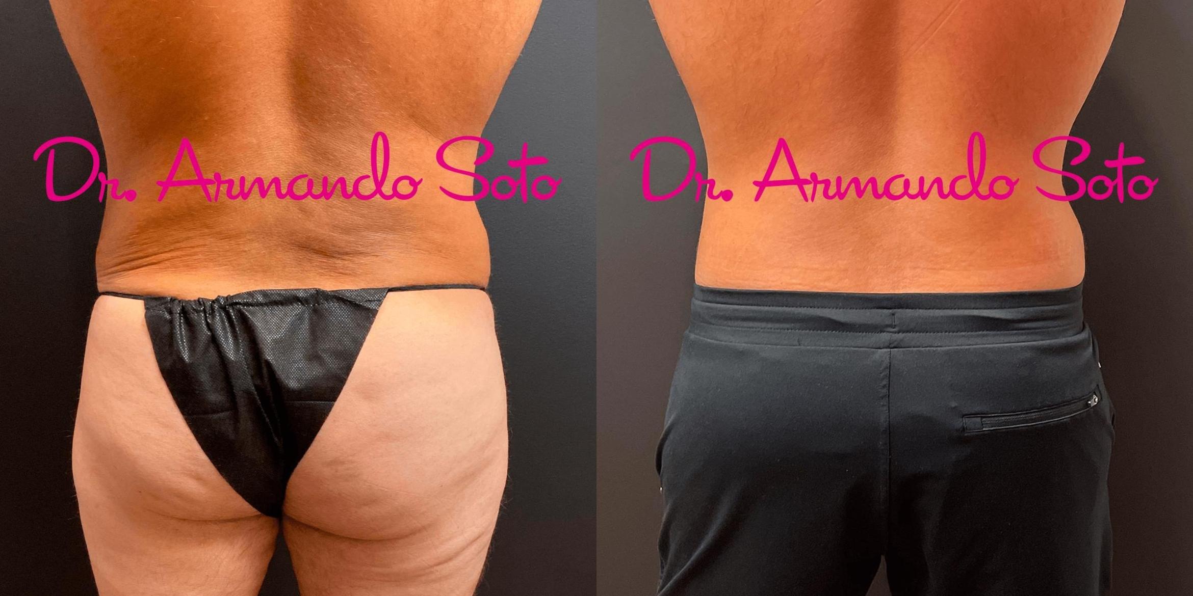 Before & After Lower Body Lift Case 71164 View #2 View in Orlando, FL
