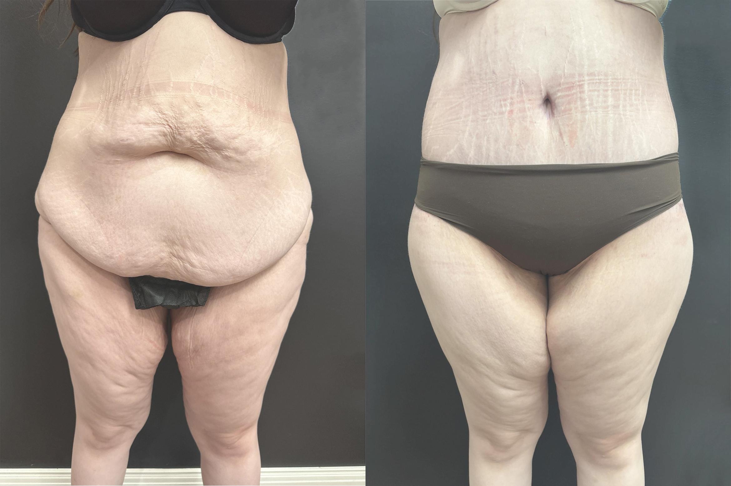 Before & After Lower Body Lift Case 76340 Front View in Orlando, FL