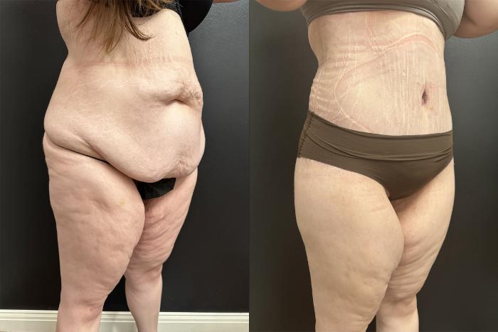 Before & After Lower Body Lift Case 76340 Right Oblique View in Orlando, FL