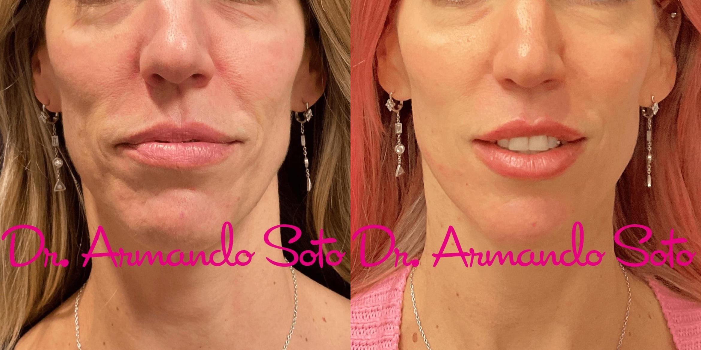 Before & After MicroLaserPeel Case 73877 View #1 View in Orlando, FL