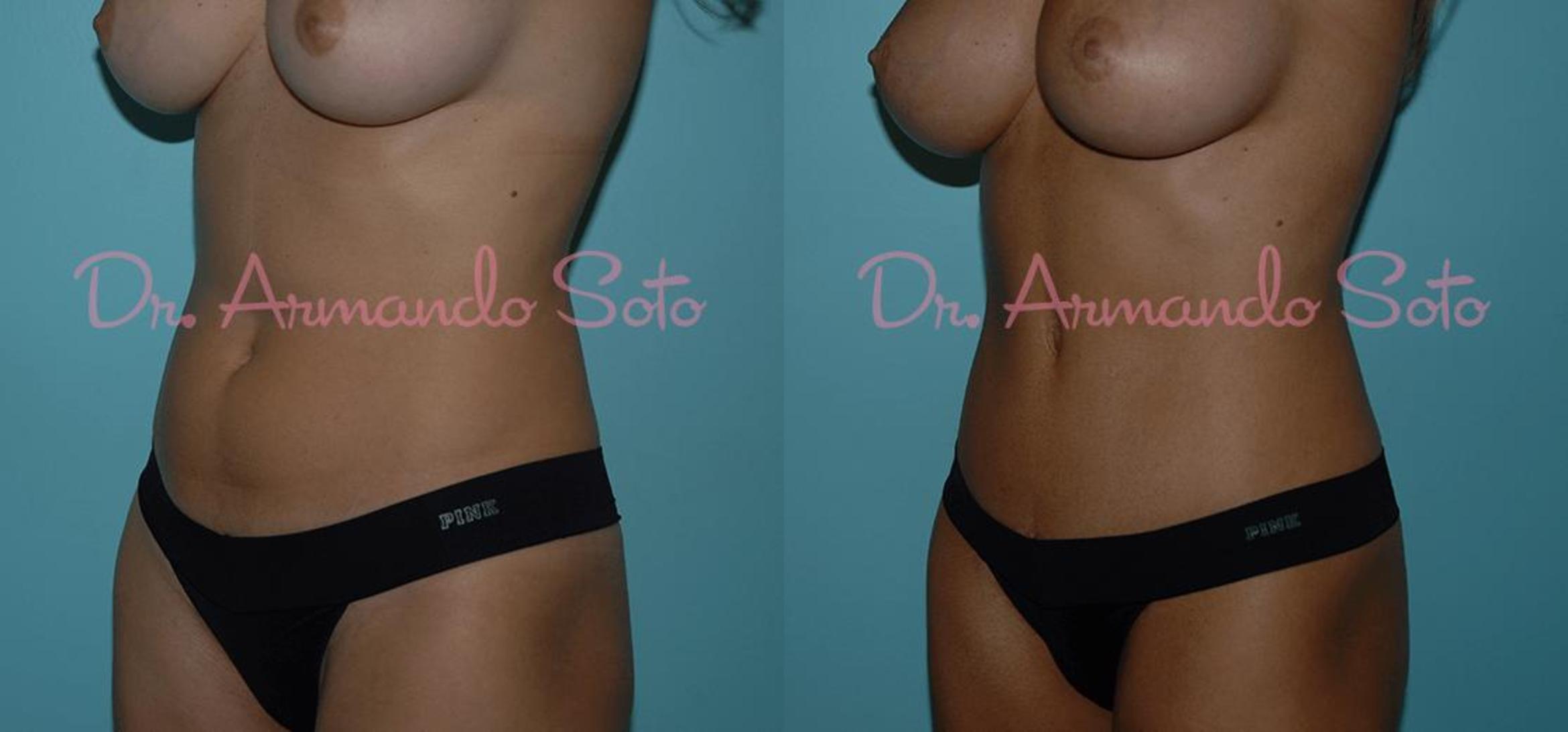 Brazilian Butt Lift in Orlando, Winter Park, FL  Aesthetic Enhancements  Plastic Surgery & Laser Center: Armando Soto, MD