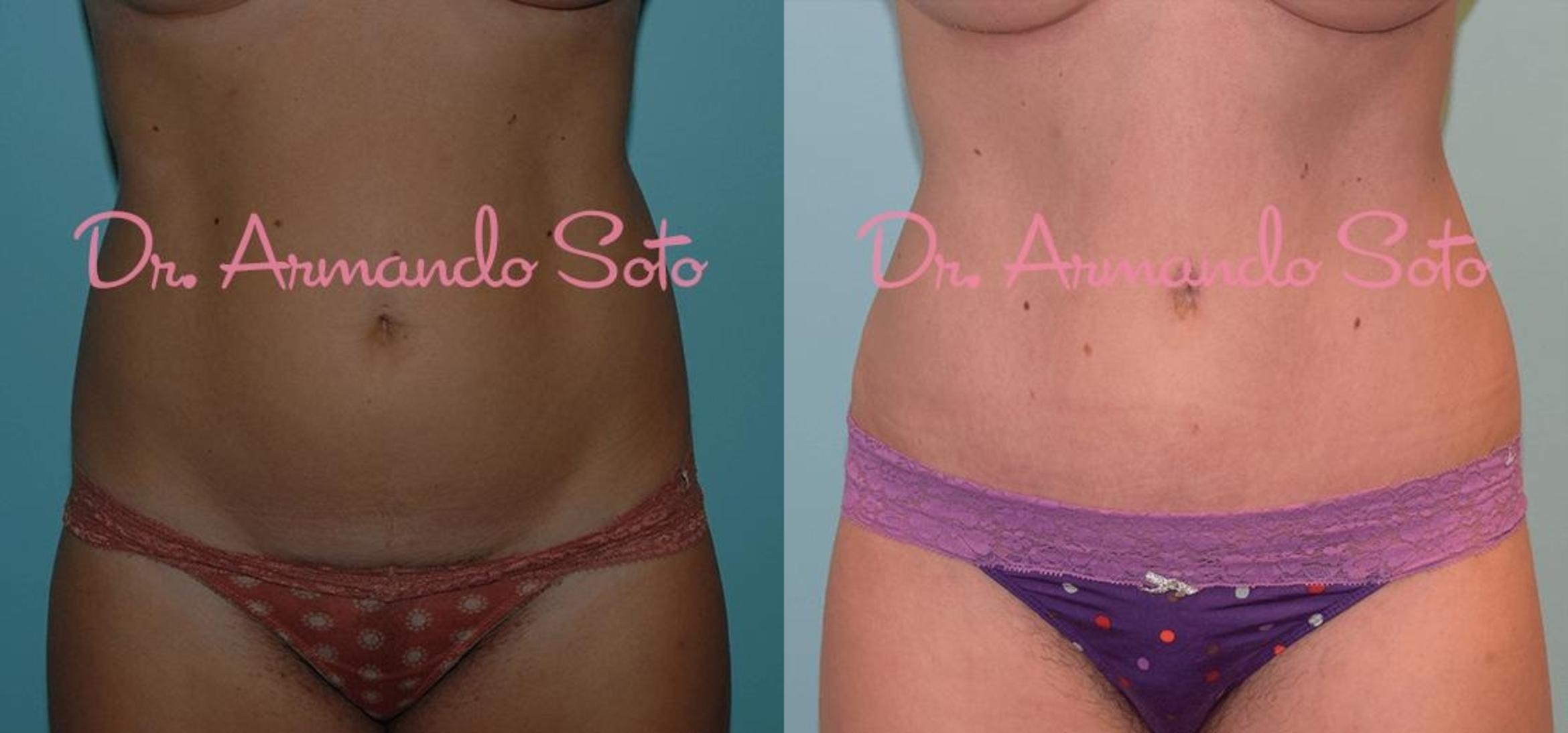 Avéli™ Cellulite Treatment in Orlando, FL  Aesthetic Enhancements Plastic  Surgery & Laser Center: Armando Soto, MD