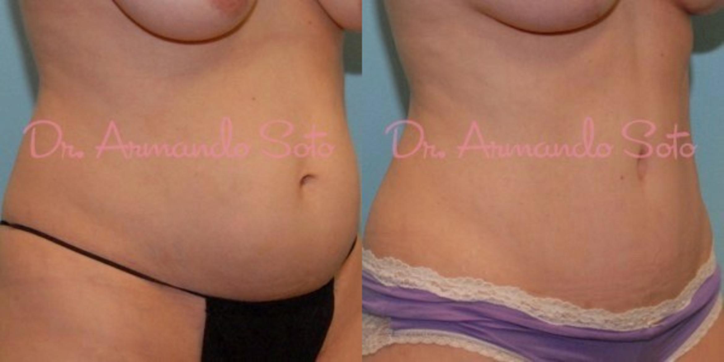 Brazilian Butt Lift in Orlando, Winter Park, FL  Aesthetic Enhancements  Plastic Surgery & Laser Center: Armando Soto, MD