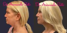 Before & After Nonsurgical Neck Lift Case 76271 View #1 View in Orlando, FL