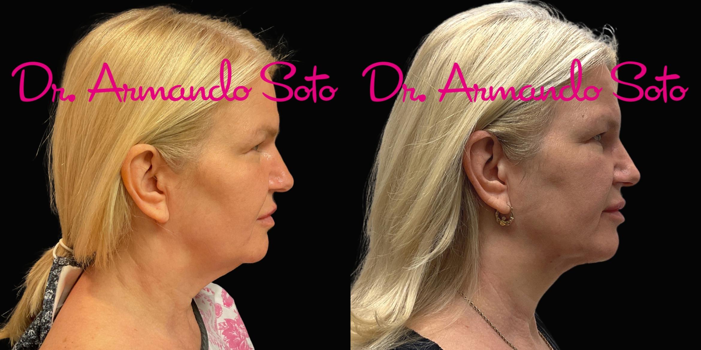 Before & After Nonsurgical Neck Lift Case 76295 Left Side View in Orlando, FL