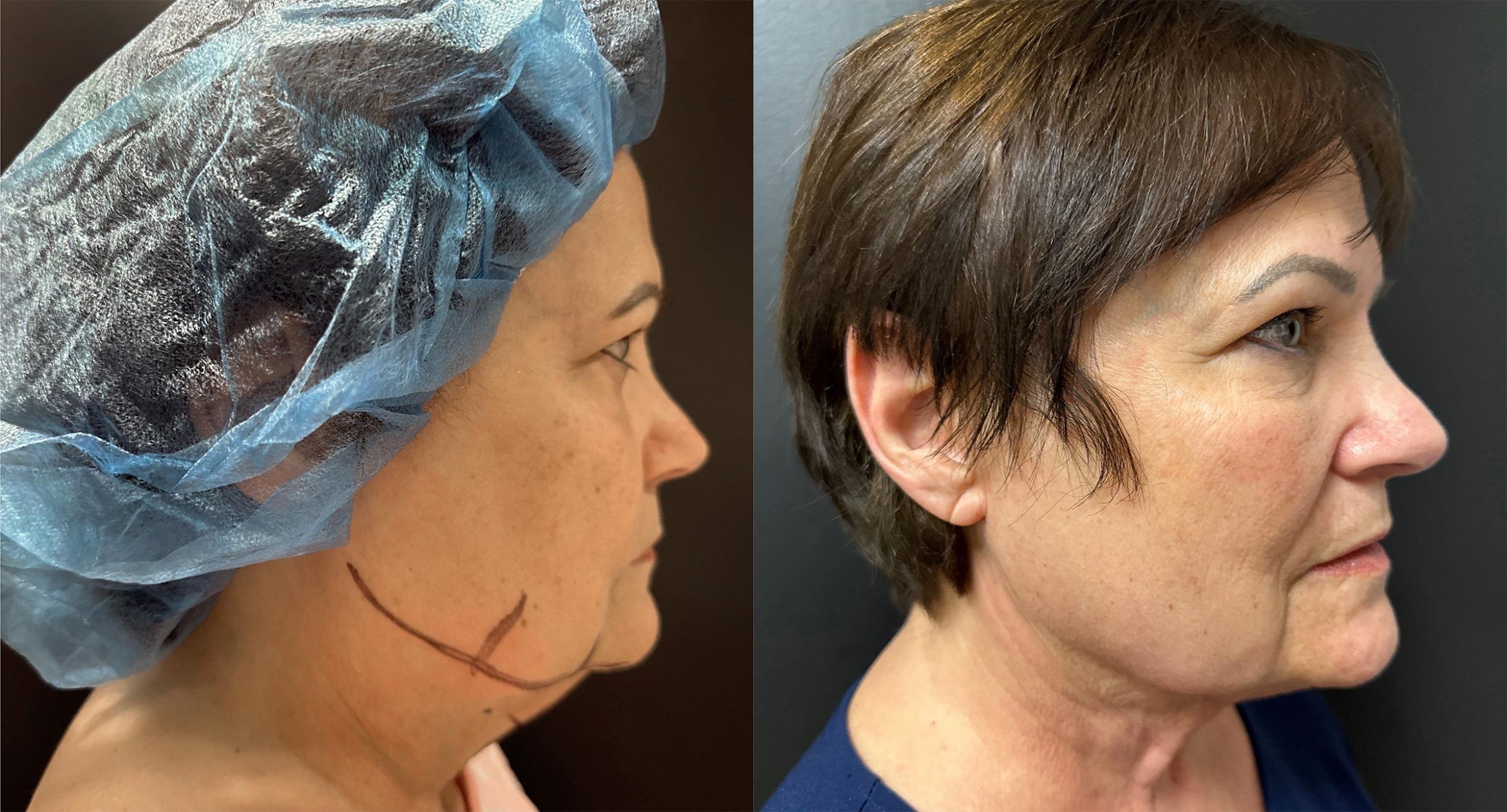 Before & After Nonsurgical Neck Lift Case 76334 Right Side View in Orlando, FL