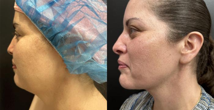 Before & After Nonsurgical Neck Lift Case 76335 Left Side View in Orlando, FL