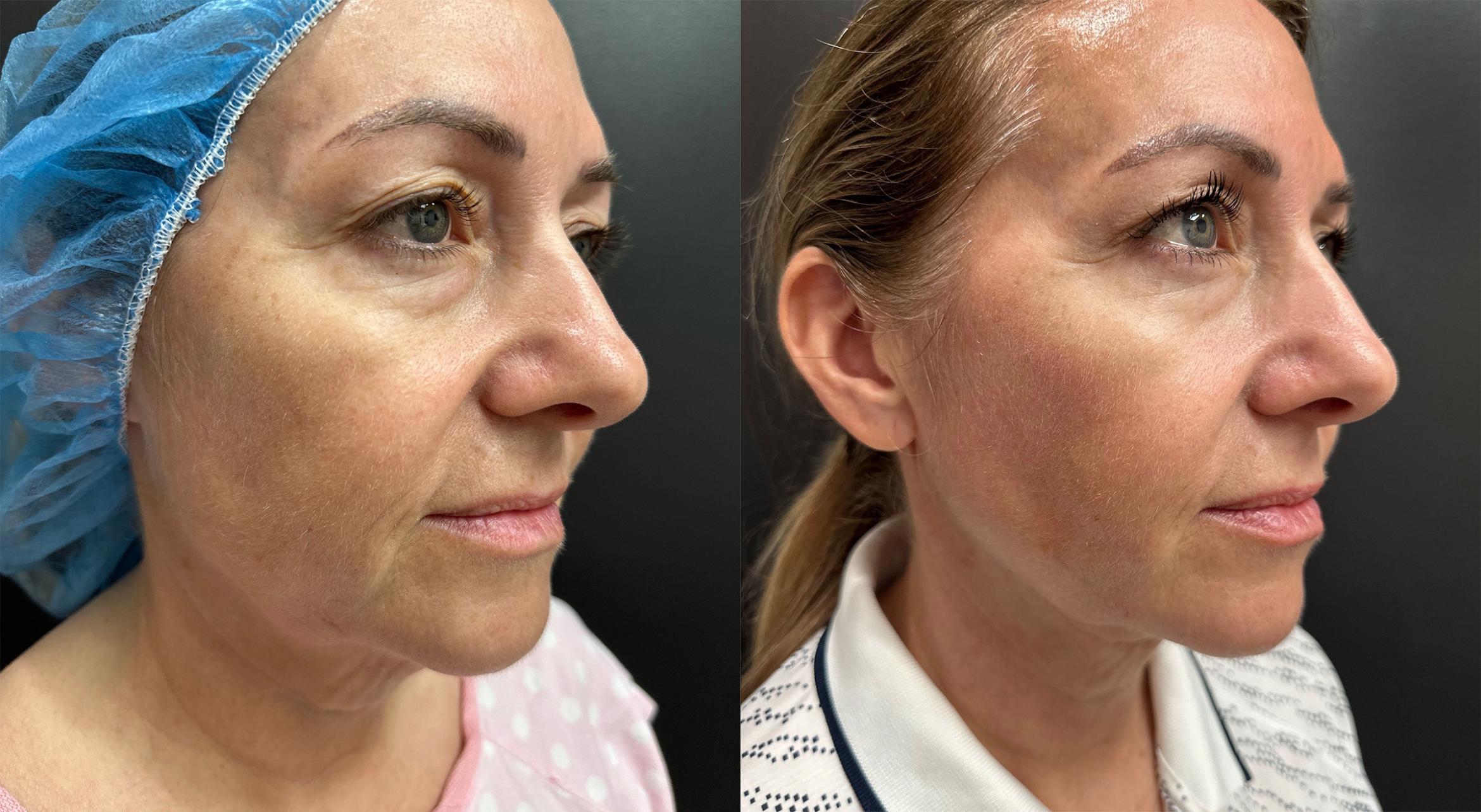 Before & After Nonsurgical Neck Lift Case 76336 Right Side View in Orlando, FL