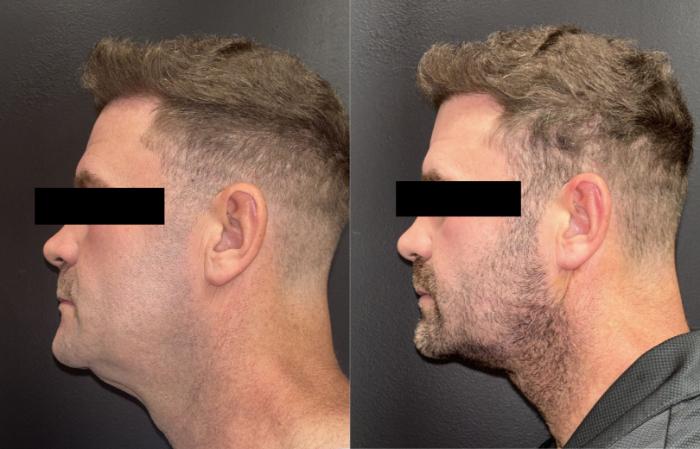 Before & After Nonsurgical Neck Lift Case 76353 Left Side View in Orlando, FL