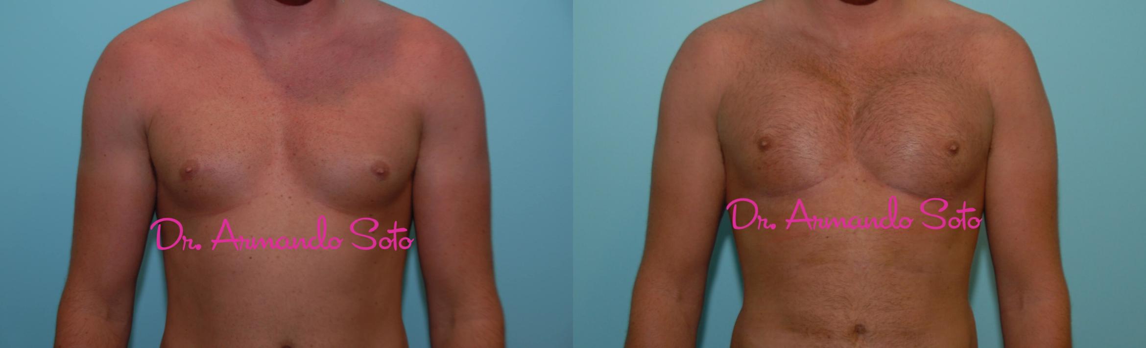 Before & After Pectoral Implants Case 23469 View #1 View in Orlando, FL
