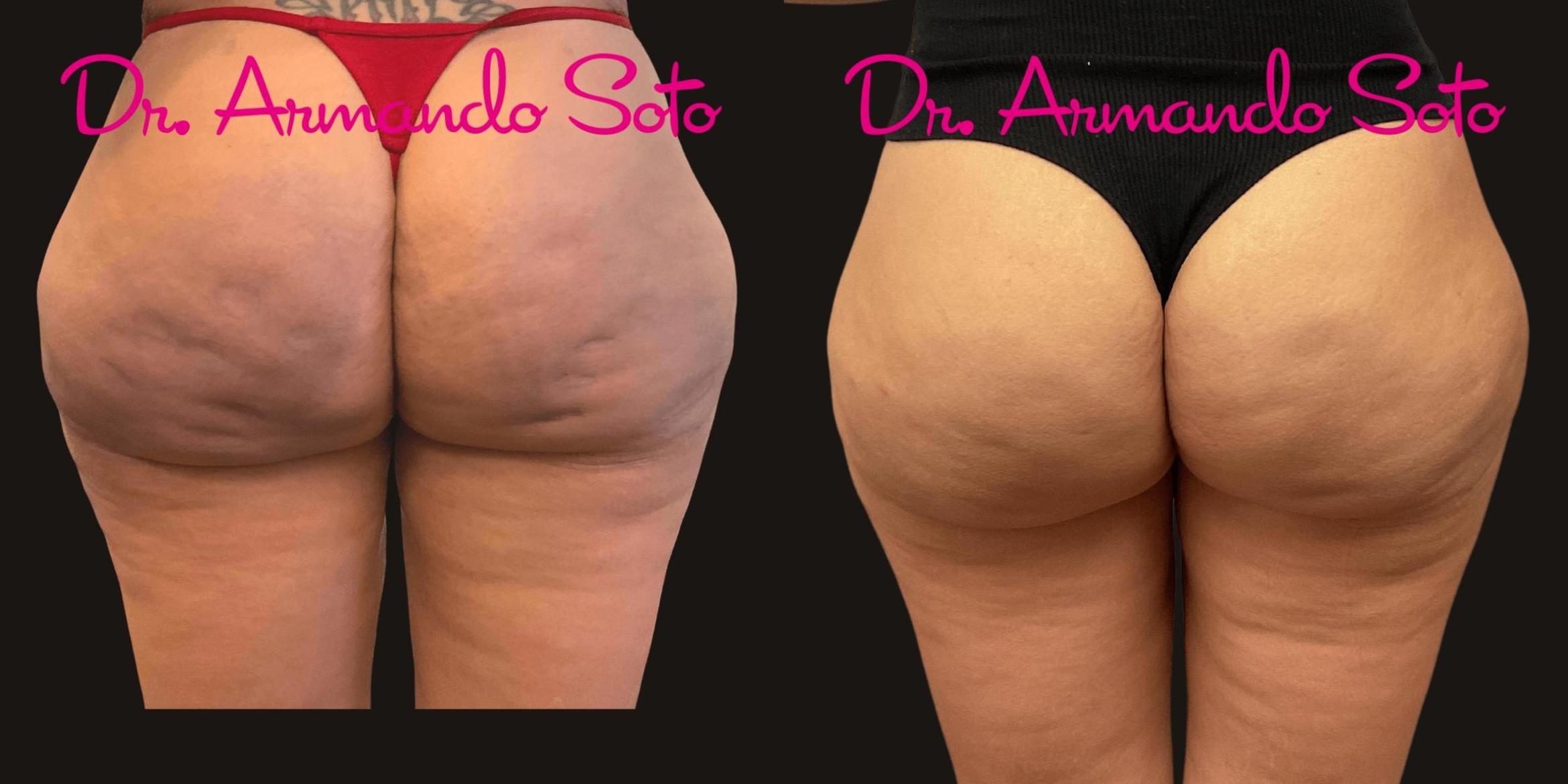 Cellulite Reduction in Orlando