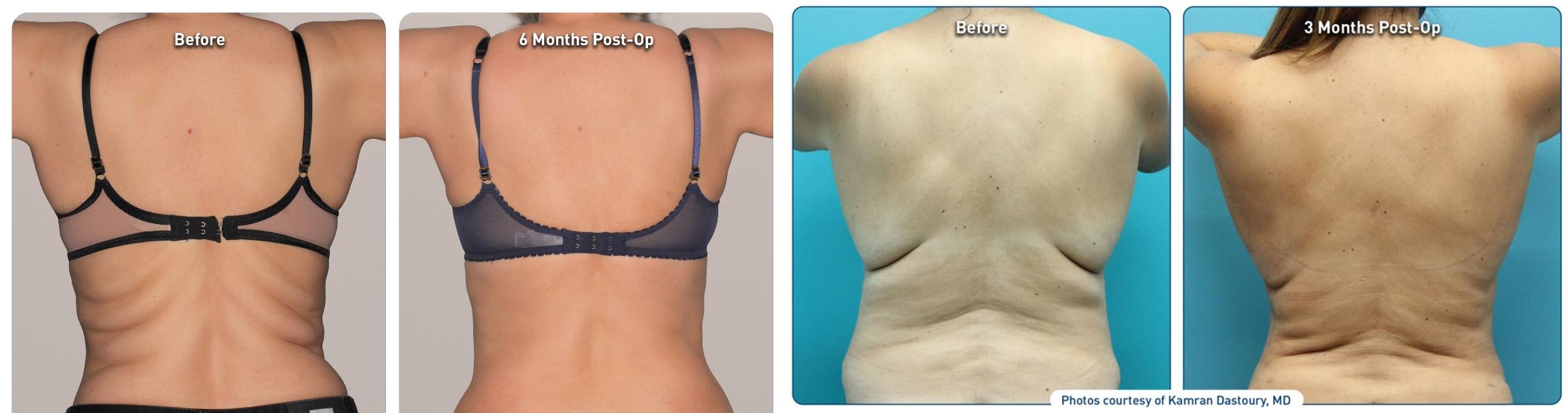Before & After Renuvion Case 76299 Back View in Orlando, FL