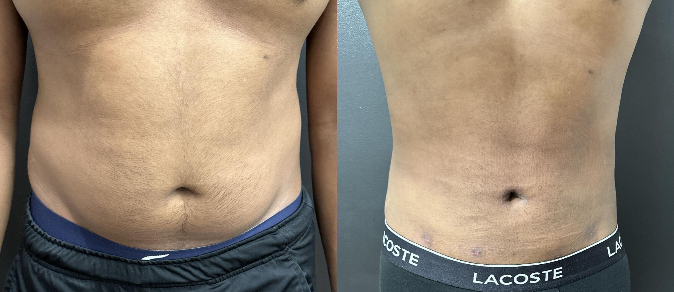 Front view before and after Renuvion treatment of the abdomen in a man