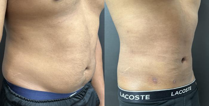 Oblique views before and after liposuction and Renuvion of the abdomen in a man