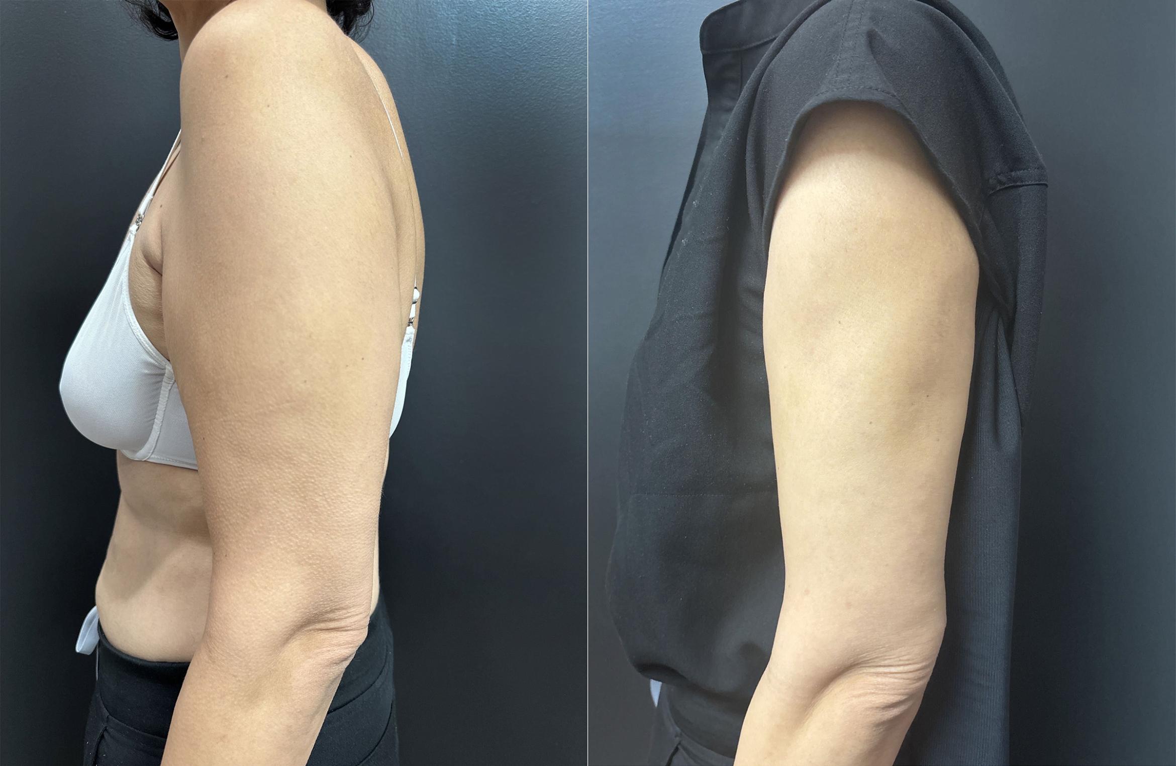 Before & After Renuvion Case 76337 Left Side View in Orlando, FL