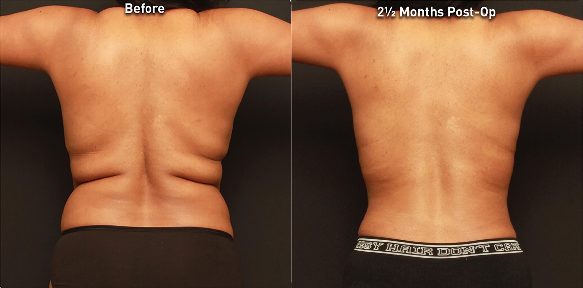 Before & After Renuvion Case 76342 Back View in Orlando, FL