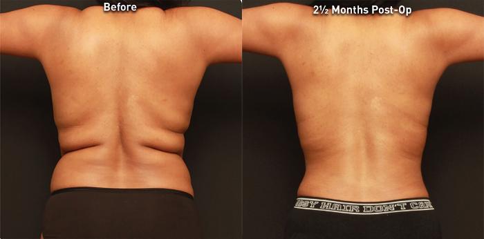 Before & After Renuvion Case 76342 Back View in Orlando, FL