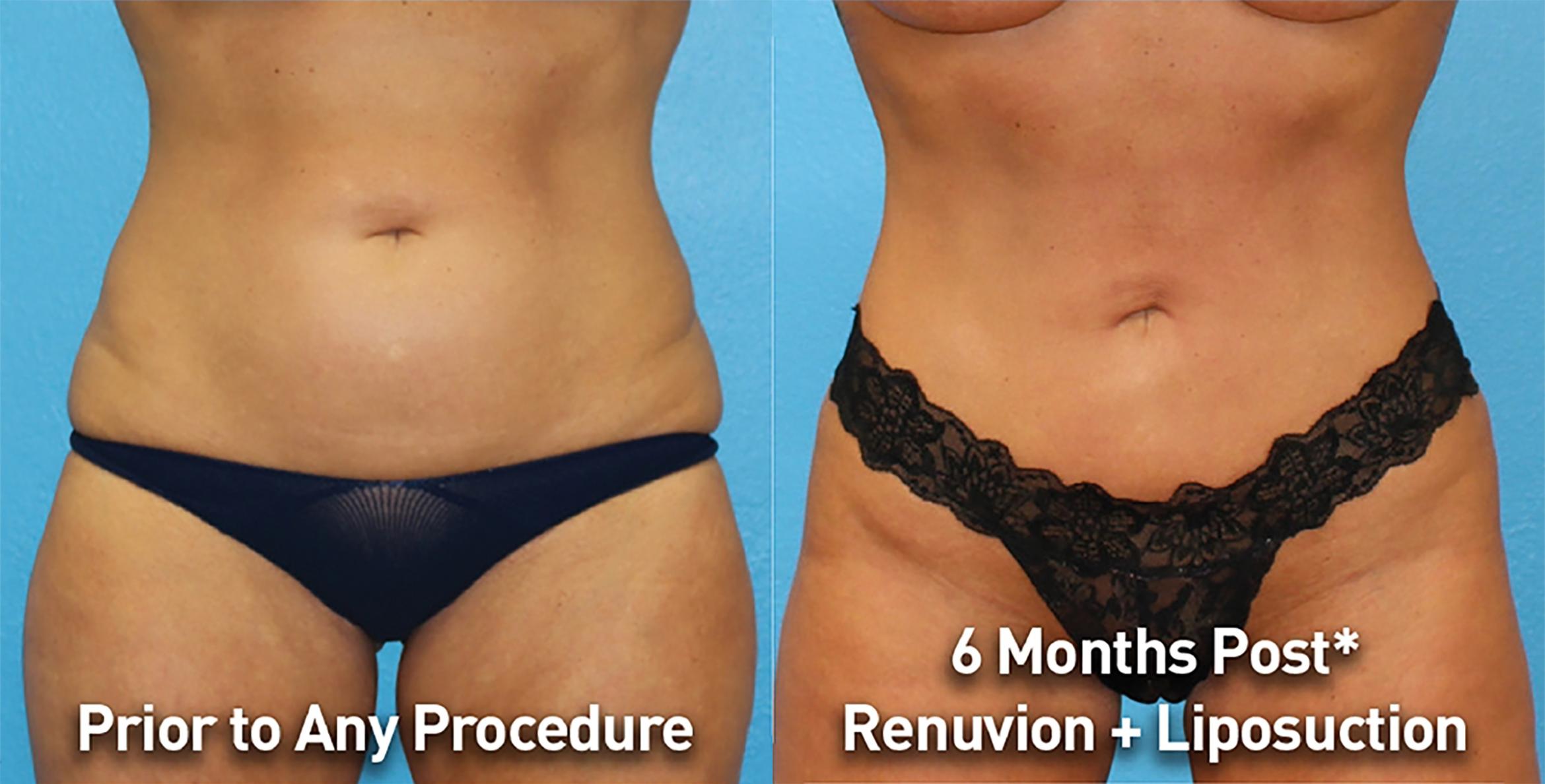 Before & After Renuvion Case 76345 Front View in Orlando, FL