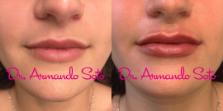 Before & After Restylane® Case 73498 View #1 View in Orlando, FL