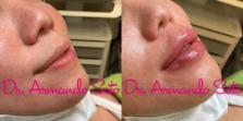 Before & After Restylane® Case 73772 View #1 View in Orlando, FL