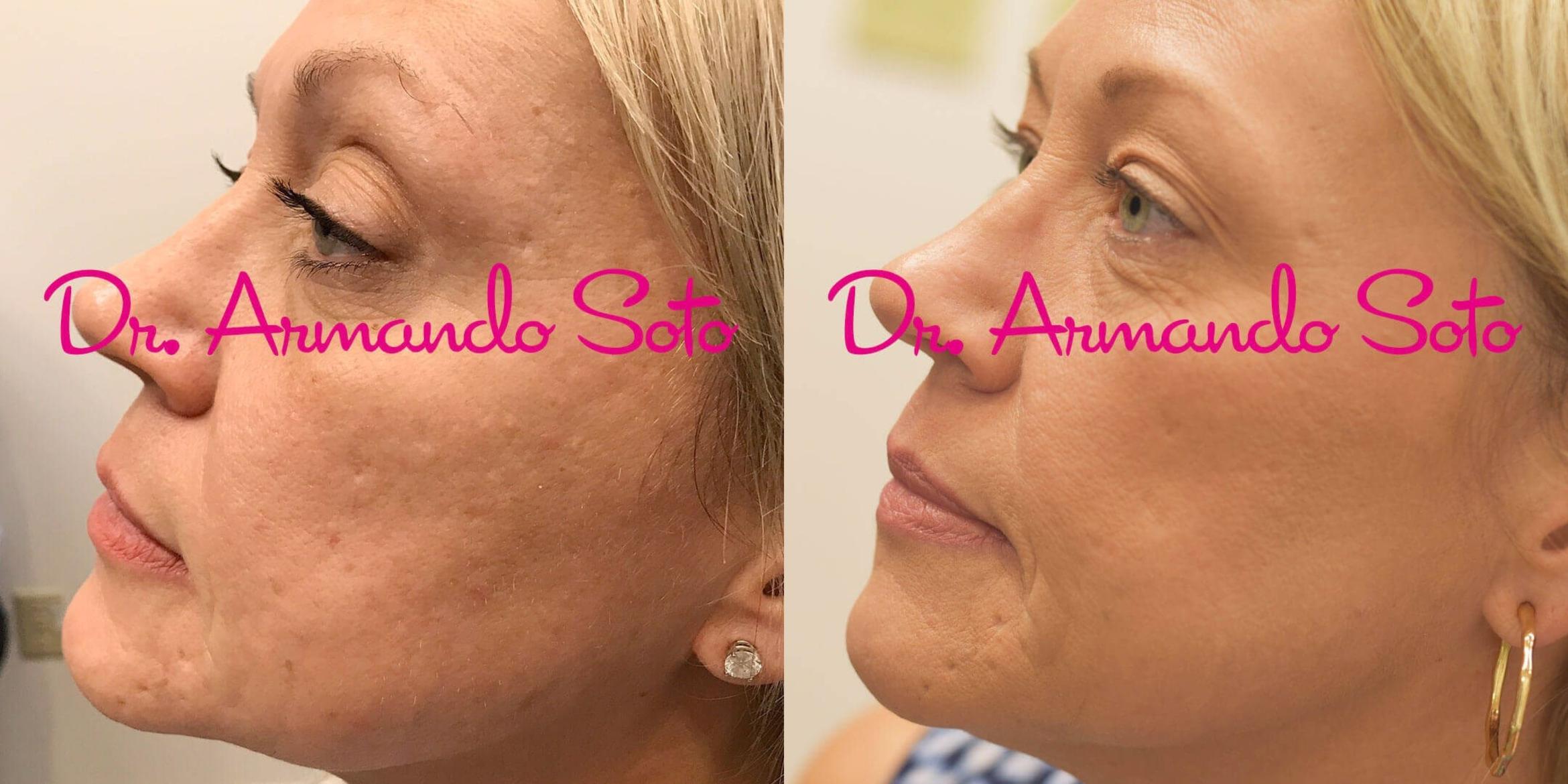 Before & After RF Microneedling Case 54011 View #1 View in Orlando, FL