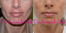 Before & After RF Microneedling Case 67272 View #1 View in Orlando, FL