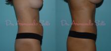 Before & After Tummy Tuck Case 23314 View #1 View in Orlando, FL