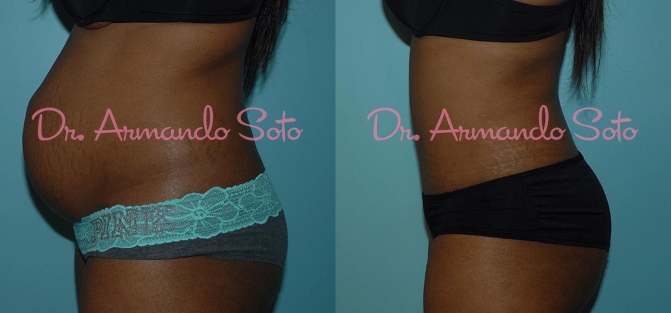 Before & After Tummy Tuck Case 23316 View #2 View in Orlando, FL