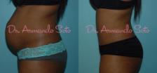 Before & After Tummy Tuck Case 23316 View #2 View in Orlando, FL