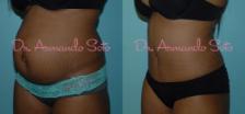 Before & After Tummy Tuck Case 23316 View #3 View in Orlando, FL